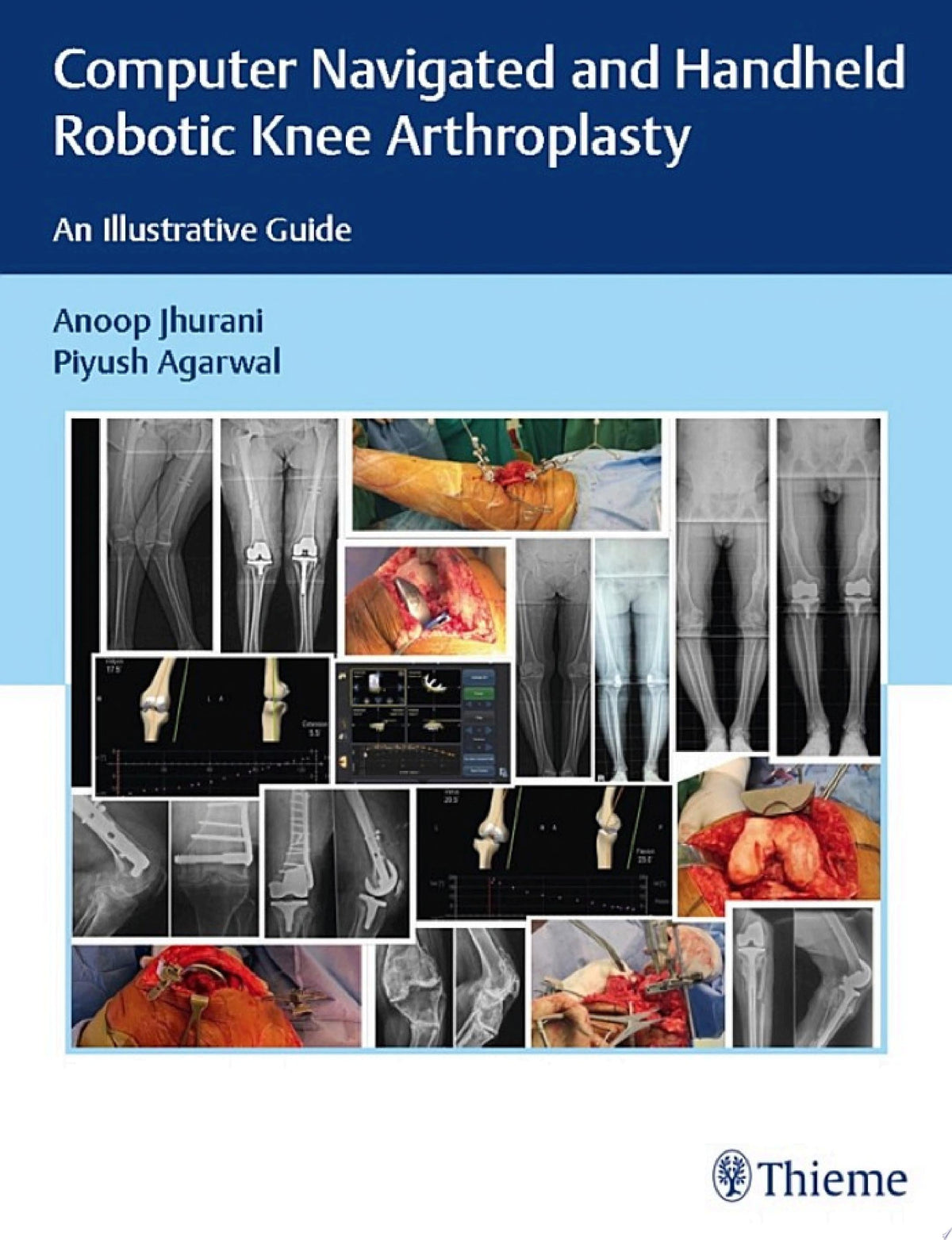 Computer Navigated and Handheld Robotic Knee Arthroplasty: An Illustrative Guide
