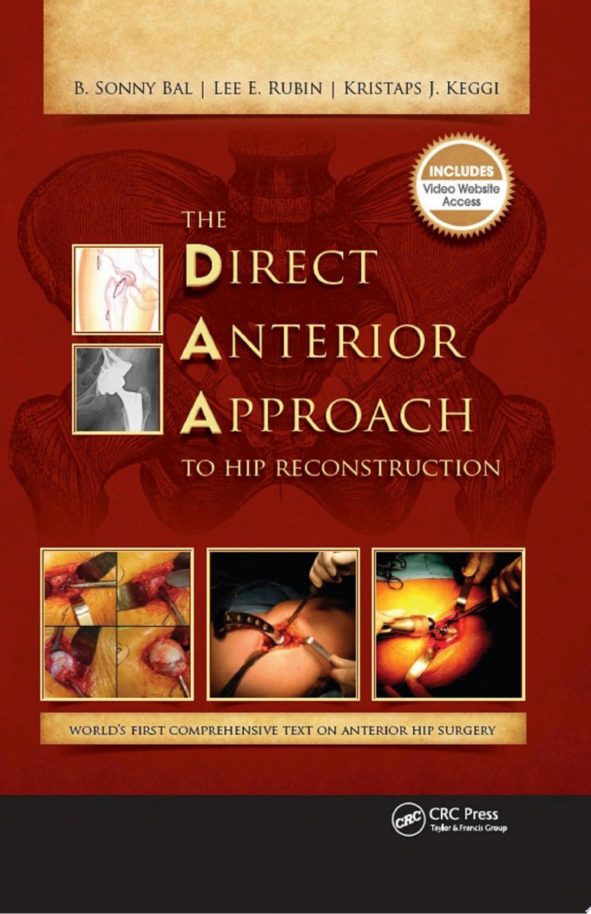 The Direct Anterior Approach to Hip Reconstruction