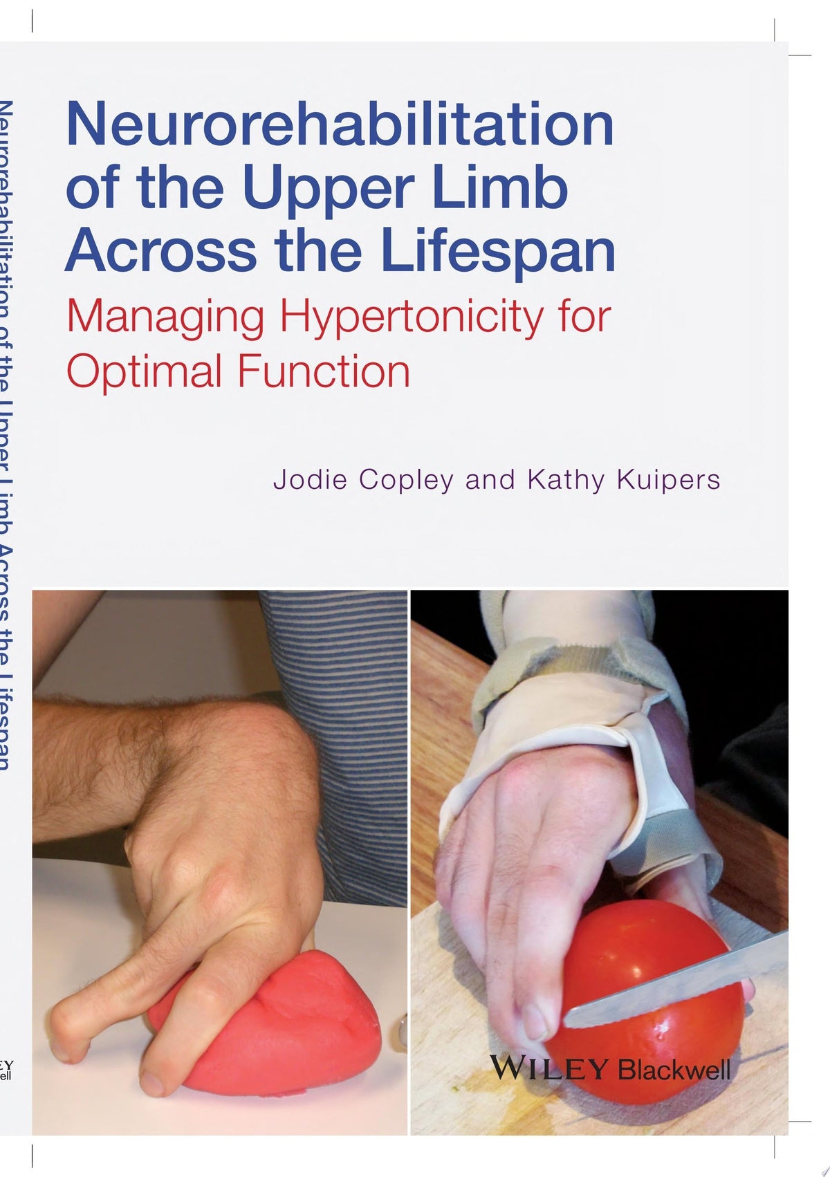Neurorehabilitation of the Upper Limb Across the Lifespan: Managing Hypertonicity for Optimal Function