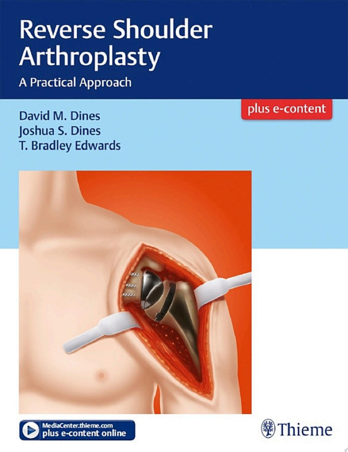 Reverse Shoulder Arthroplasty: A Practical Approach